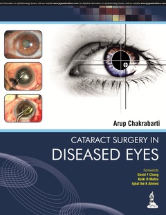 Couverture de l’ouvrage Cataract Surgery in Diseased Eyes