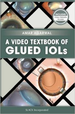 Couverture de l’ouvrage A video textbook of glued IOLs 