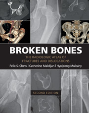 Cover of the book Broken Bones