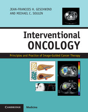 Couverture de l’ouvrage Interventional Oncology
