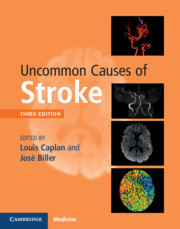Couverture de l’ouvrage Uncommon Causes of Stroke