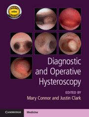 Couverture de l’ouvrage Diagnostic and Operative Hysteroscopy