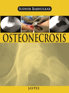 Couverture de l’ouvrage Osteonecrosis