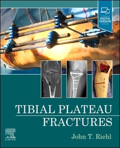 Couverture de l’ouvrage Tibial Plateau Fractures