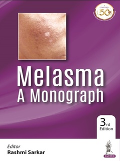 Couverture de l’ouvrage Melasma: A Monograph