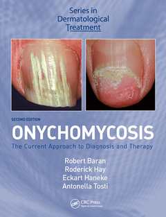 Couverture de l’ouvrage Onychomycosis