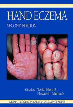 Couverture de l’ouvrage Hand Eczema (Dermatology : Clinical & Basic Science Series)